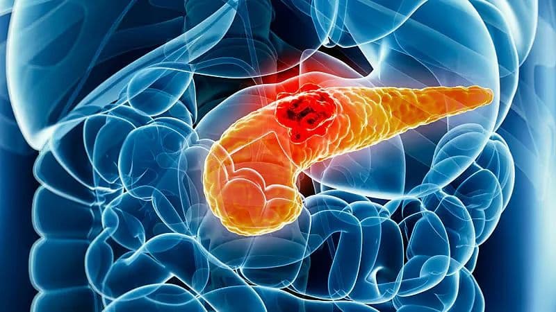 പ്രായമായവരിൽ പാൻക്രിയാറ്റിക് കാൻസറിനുള്ള സാധ്യത കൂടുതൽ